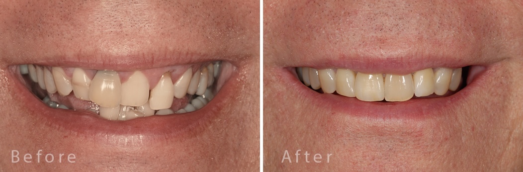 Invisalign